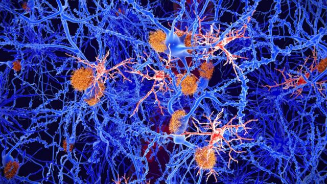 Imagen mejorada por computadora del cerebro que muestra la beta amiloide