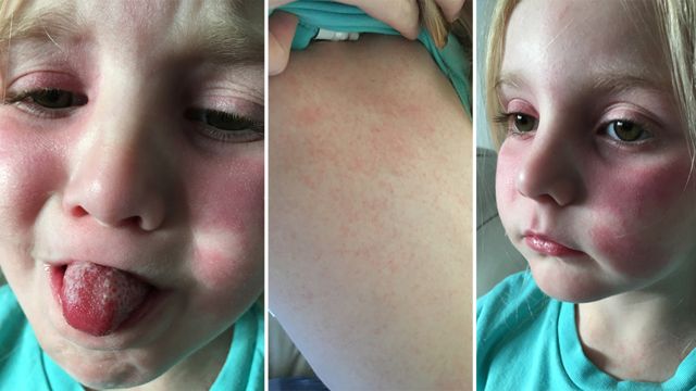 Rise in scarlet fever cases shows 49-year high, health experts say - BBC  News