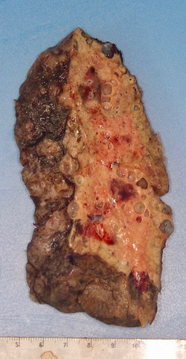 Imagem do pulmão substituído em transplante