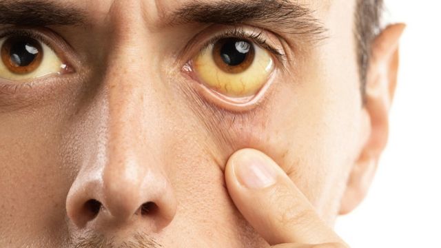 Um homem abre os olhos que estão com cor amarelada