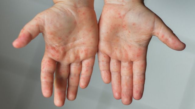 Hands with measles.