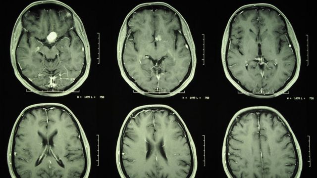 Tomografia de um cérebro