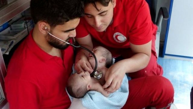 Врачи с сиамскими близнецами