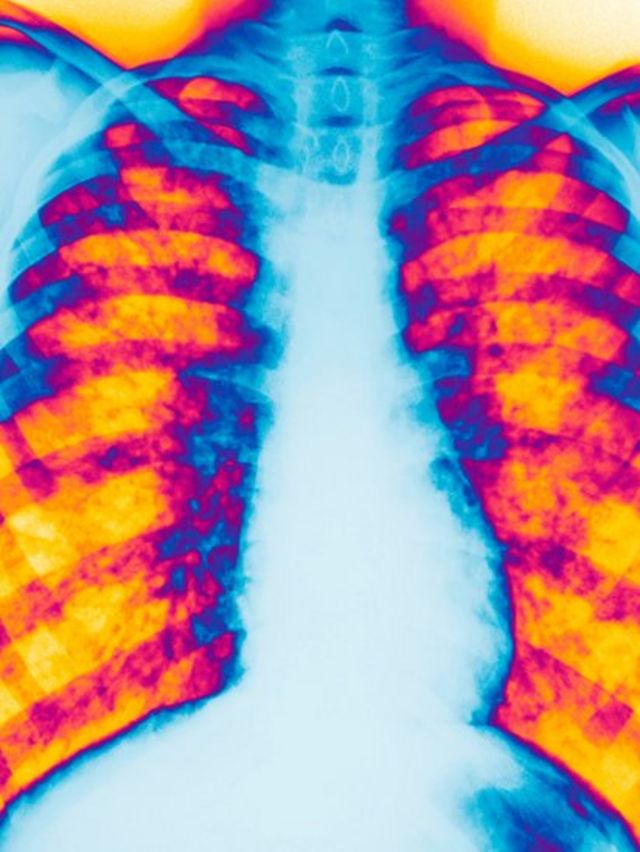 Radiografía de una persona con fibrosis quística.