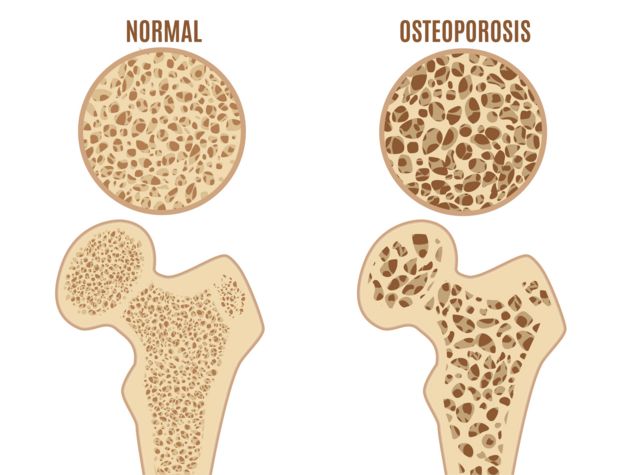 osteoporosis - ஆஸ்டியோபோரோசிஸ்