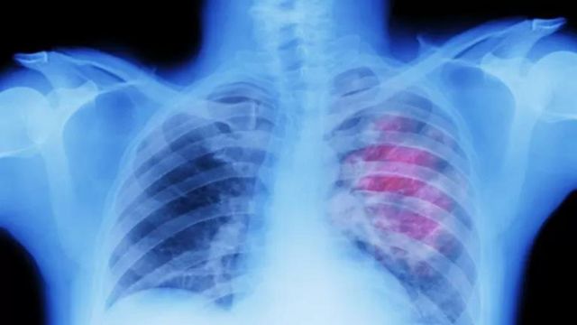 Utambuzi wa mapema unaweza kuzuia saratani kuenea kwa mwili wote.