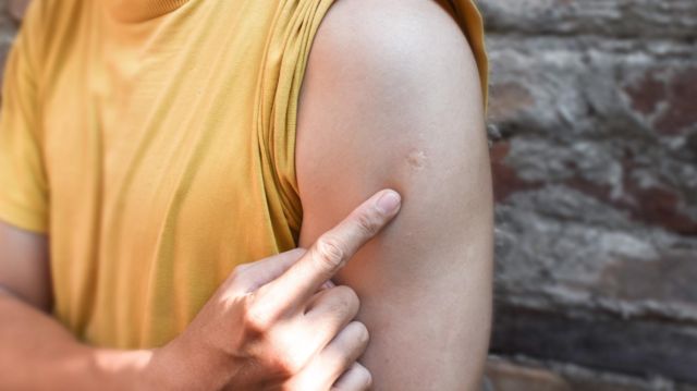 Pessoa mostrando marca da vacina BCG no seu braço