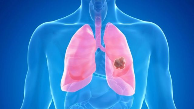 ஆஸ்துமா, விழிப்புணர்வு, மாசு, மாஸ்க்