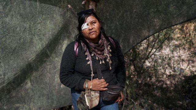 Elva Valério ferida no olho por uma das balas de borracha disparadas pelos policiais