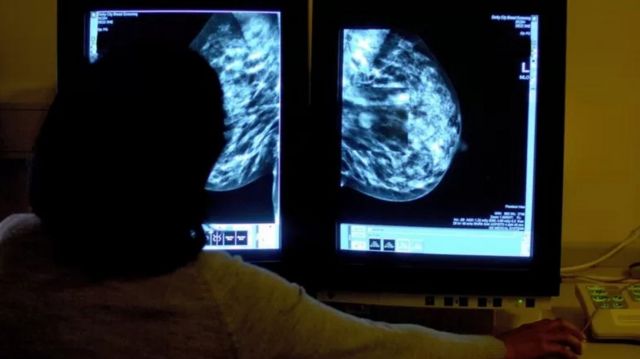 Cancer du sein : 6 facteurs qui augmentent le risque - BBC News Afrique