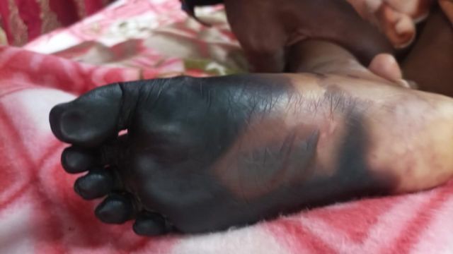 கருகிய கால்