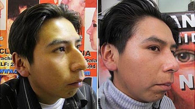 Cheap Nose Jobs Change The Face Of Bolivia Bbc News