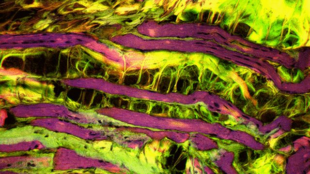Muscle fibres (purple) are replaced by fat (black) in muscular dystrophy