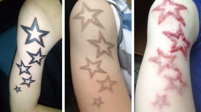 Laser tattoo removal is on the rise, say skin experts - BBC News