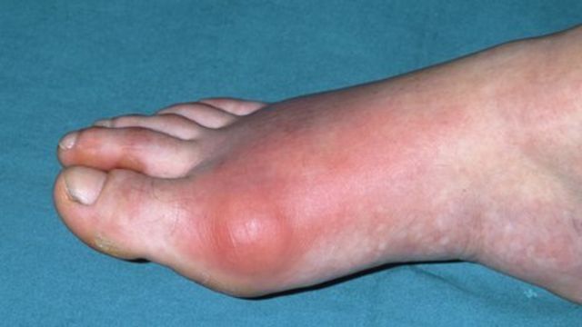 Rates Of Gout In Uk Soaring Bbc News