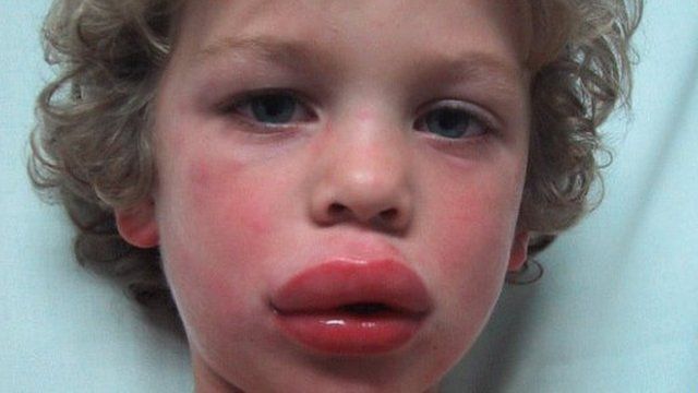 A young boy having an anaphylactic reaction