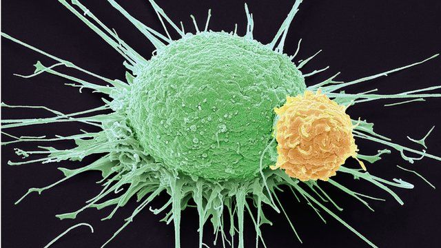 Prostate cancer and immune cells