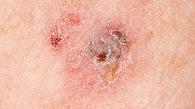 Close-up of melanoma skin cancer