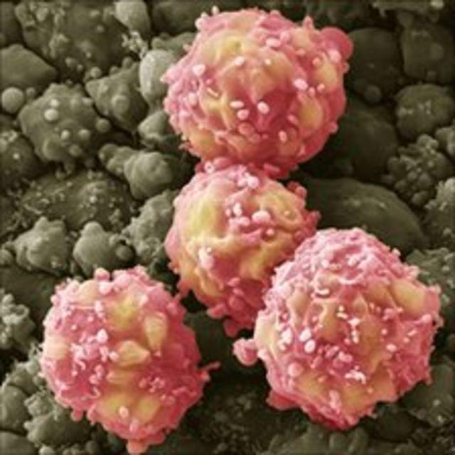 Stroke patients see signs of recovery in stem-cell trial