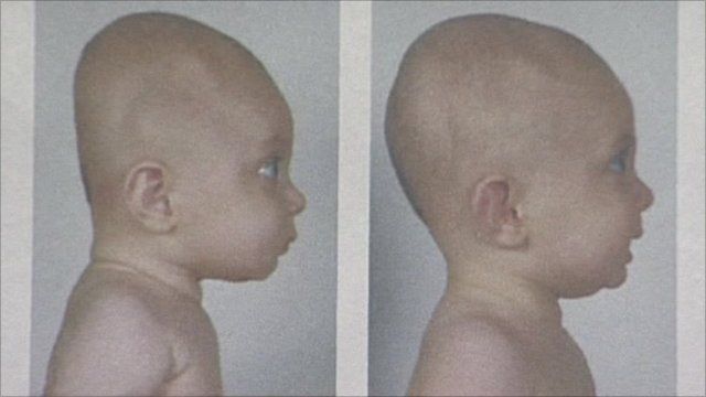 Warning Over Flat Head Syndrome Treatment Bbc News