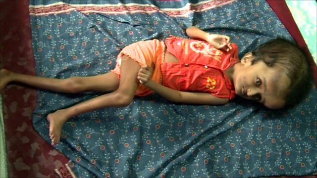 Child with hydrocephalous