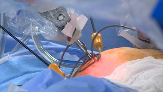 Robot surgeon first for hospital - BBC News