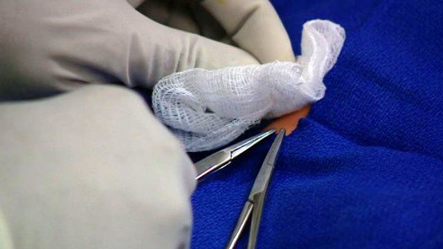 A Doctors Guide To Male Circumcision Bbc News 