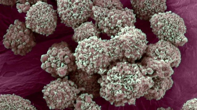 Breast cancer cells