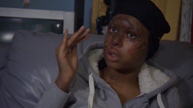 Naomi Oni, victim of acid attack