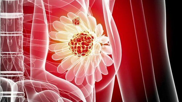 Breast cancer graphic