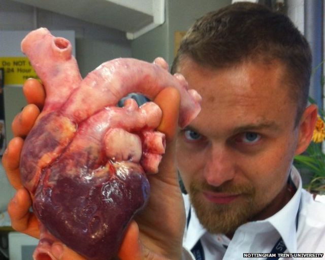 3D printing helps surgeons plan life-saving operation