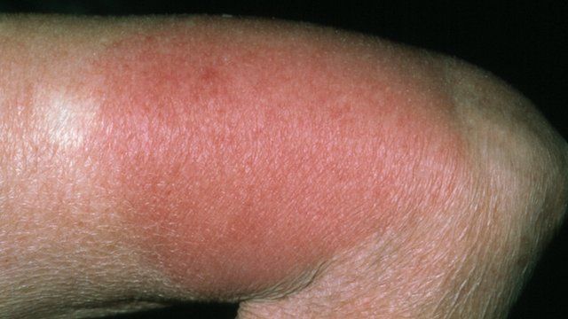 Drug allergies: Culprit protein found - BBC News