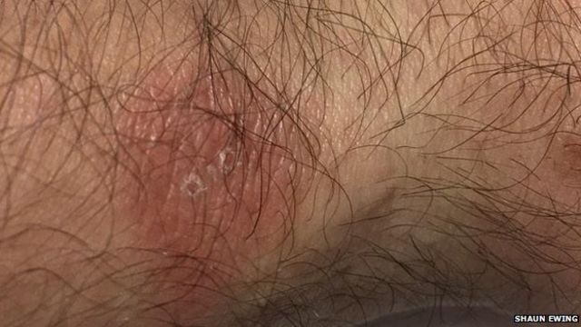Fitbit says new wearable device can cause skin rash