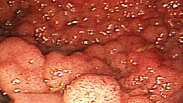 Pioneering surgery 'saves bowels' when removing polyps