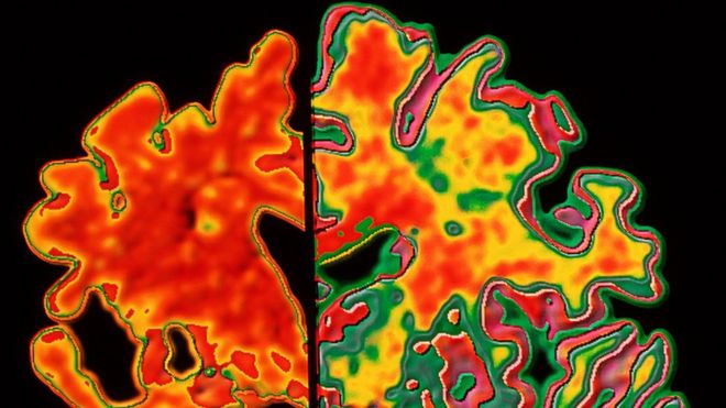 Изображение мозга с болезнью Альцгеймера и без мозга