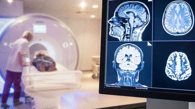 El personal de radiología realiza una resonancia magnética de un cerebro.