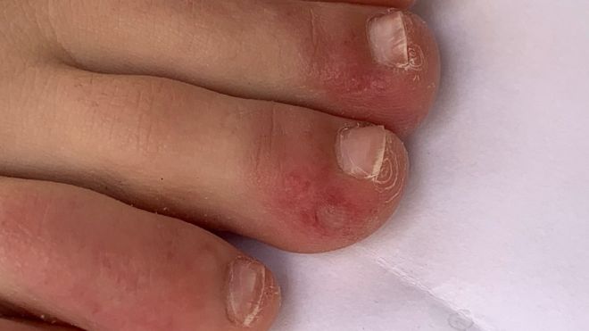 symptoms discolored toes