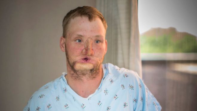 Энди Сэнднесс перед операцией. Его лицо покрыто шрамами, а ширина рта всего дюйм. У него протез носа.