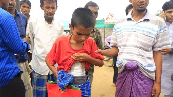 Раненый мальчик рохинджа поднимает свою футболку, чтобы показать большую повязку на животе