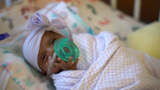 Premature baby in intensive care at Sharp Mary Birch Hospital