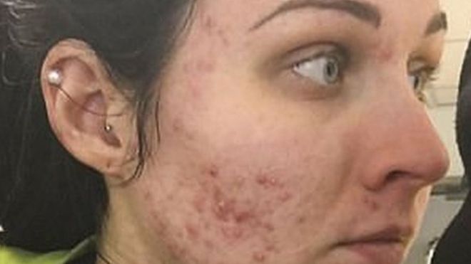 Medicamentos para el acne severo