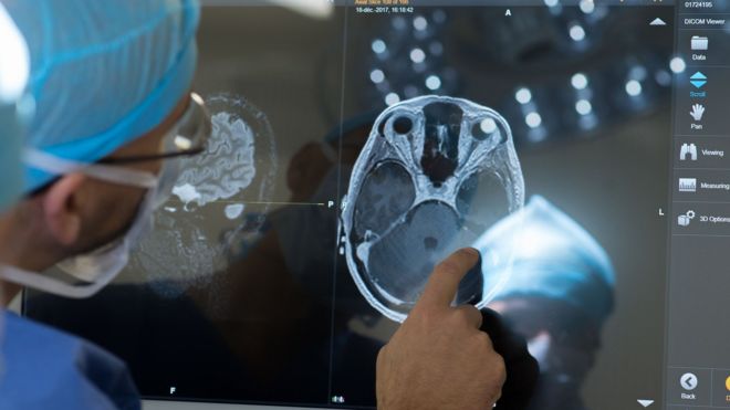 A doctor examines a brain scan.