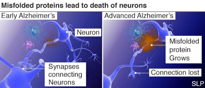 Инфографика, показывающая разницу между ранней и поздней стадиями болезни Альцгеймера