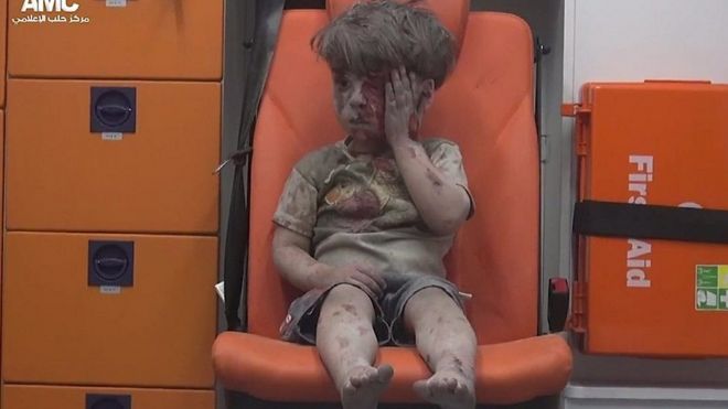 Niño herido en Alepo, Siria