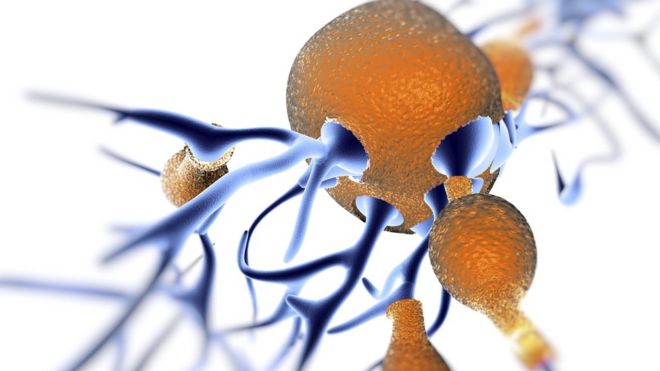 Computer artwork showing amyloid plaques (in brown) in the brain which kill surrounding neurons (in blue)
