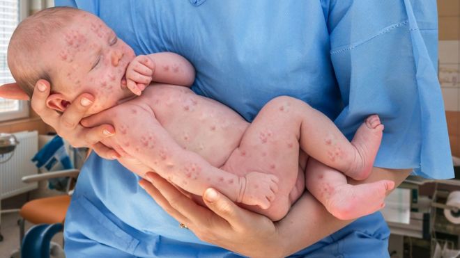 Mitos sobre las vacunas que pueden explicar los nuevos brotes de una enfermedad fácilmente evitable