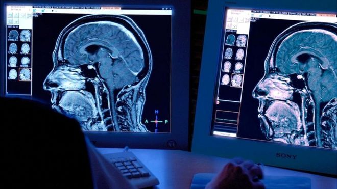Imágenes computarizadas de cerebros.