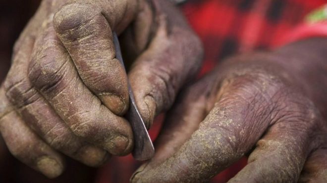 Plus de 200 millions de filles et de femmes en vie aujourd'hui ont été excisées dans le monde.