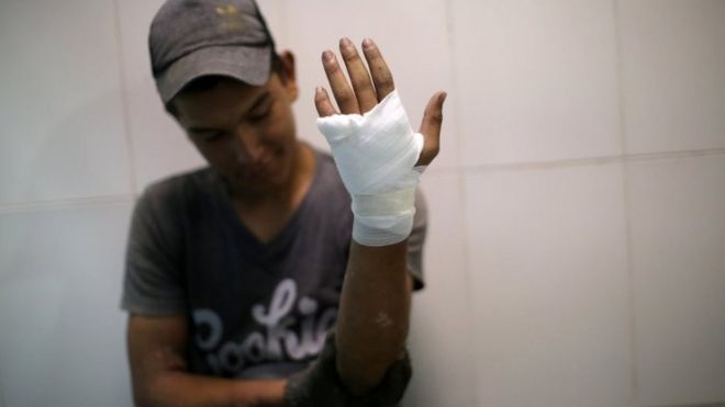 Протестующий держит поврежденную и перевязанную руку