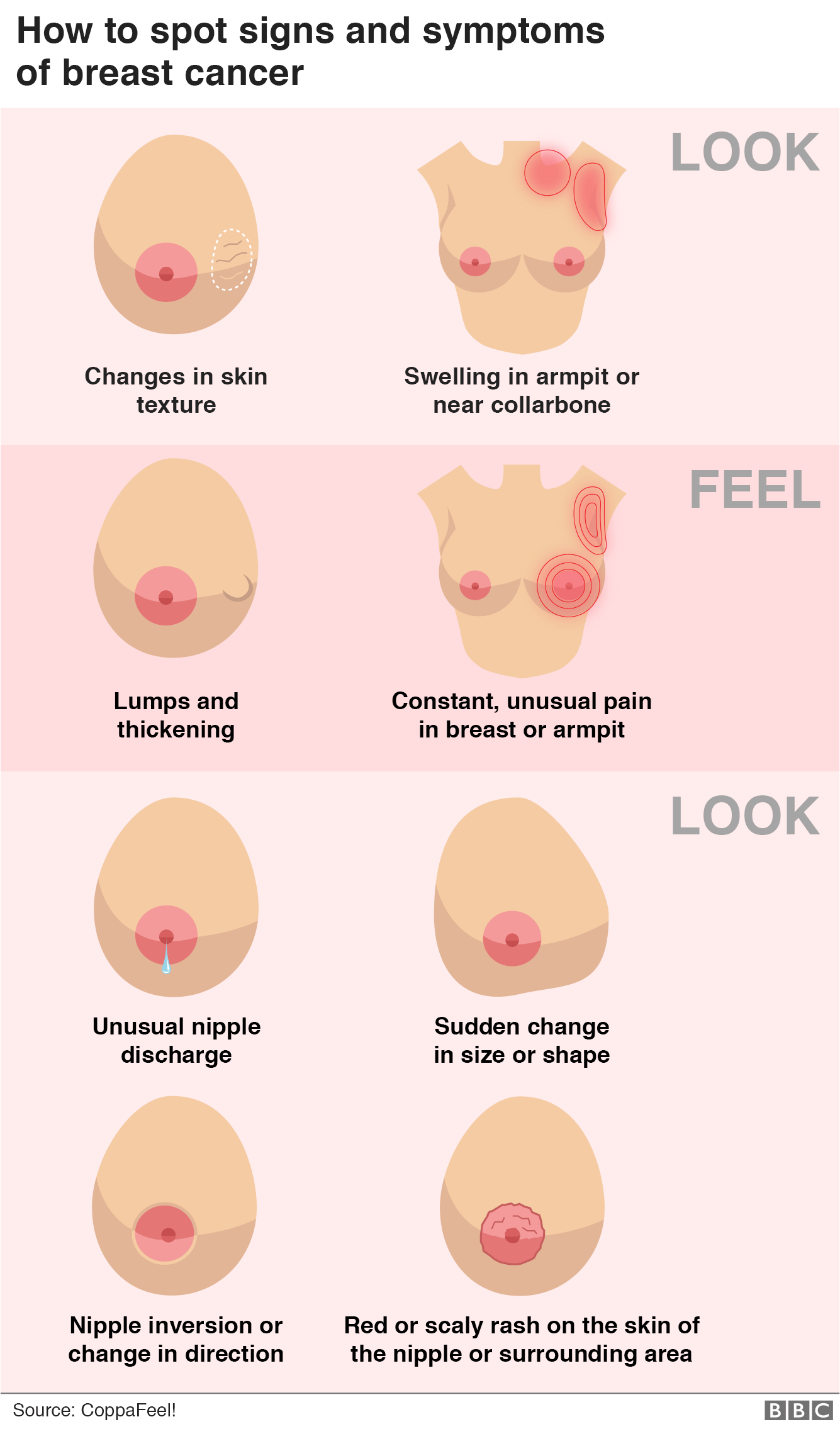 Графика, показывающая, как определить признаки и симптомы рака молочной железы